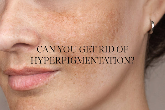 No, hyperpigmentation isn’t impossible to minimise