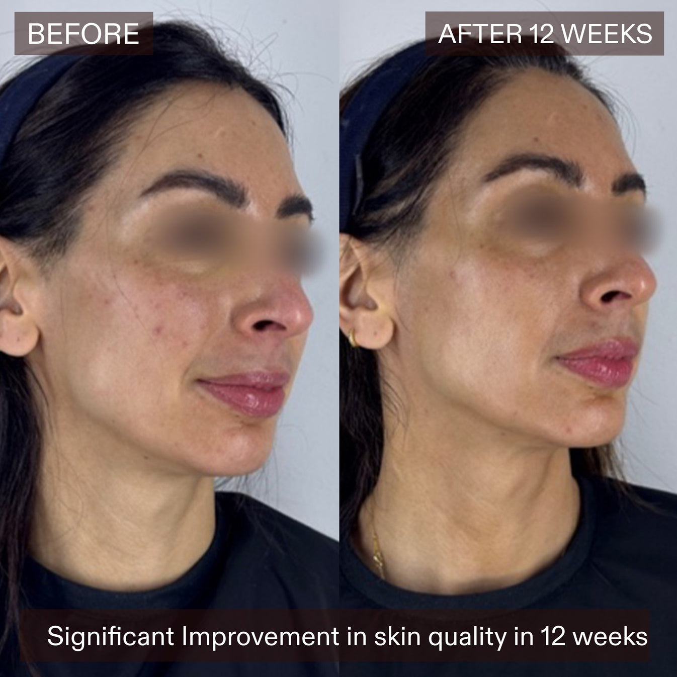 Before-and-after side-by-side comparison of a woman's face showing skin improvement after 12 weeks, with 'BEFORE' on the left and 'AFTER 12 WEEKS' on the right.