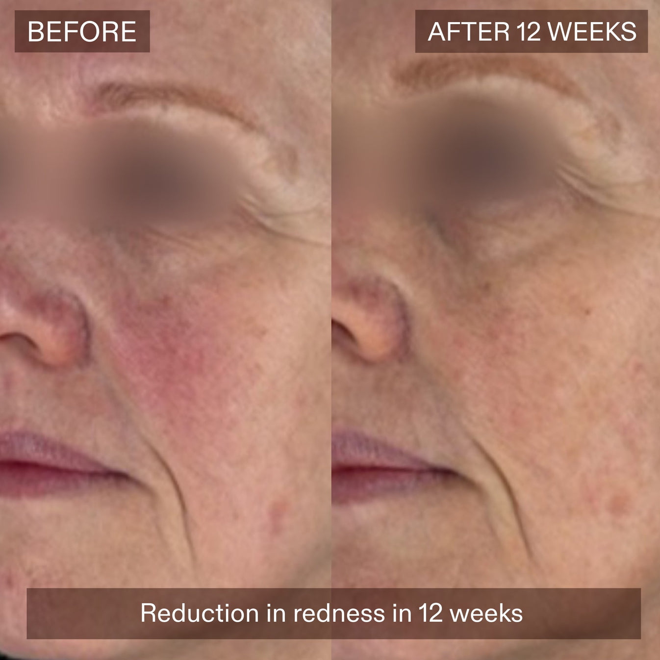 Before-and-after facial skin comparison showing a person's cheek and mouth area, with the left labeled BEFORE and the right labeled AFTER 12 WEEKS. The bottom banner reads 'Reduction in redness in 12 weeks.
