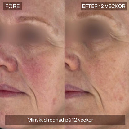 Before-and-after facial skin comparison showing a person's cheek and mouth area, with the left labeled BEFORE and the right labeled AFTER 12 WEEKS. The bottom banner reads 'Reduction in redness in 12 weeks.