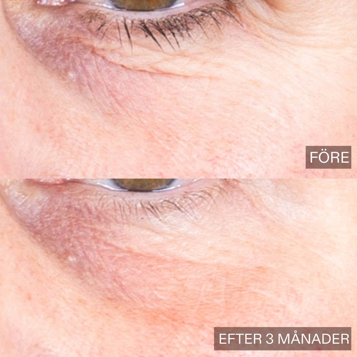 Close-up before-and-after comparison of an eye area showing skin texture and wrinkles, with 'BEFORE' on the top and 'AFTER 3 MONTHS' on the bottom.