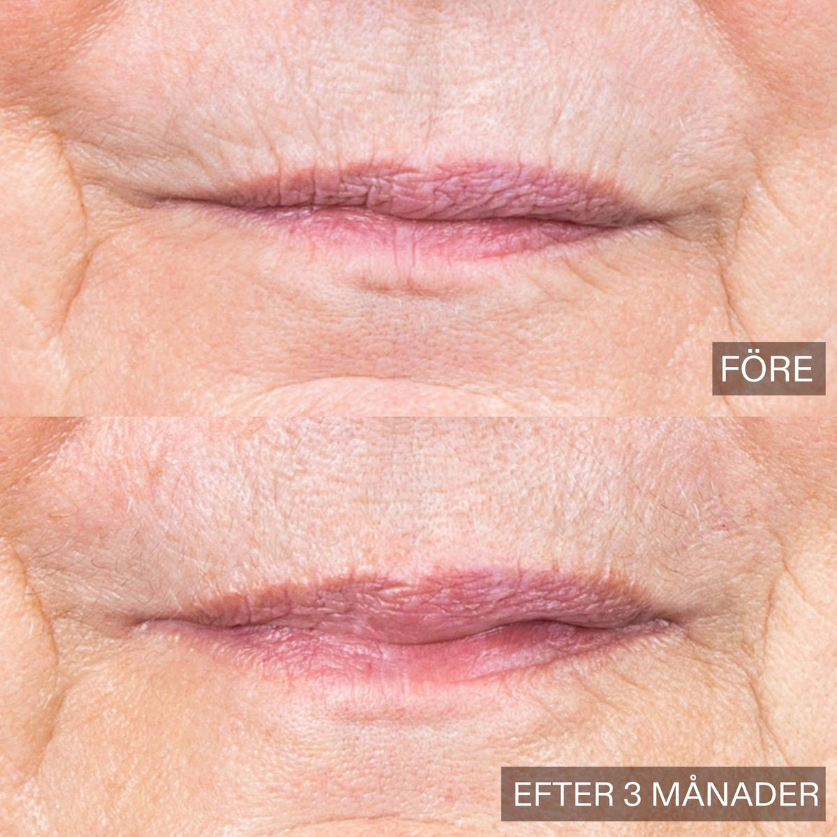 Before-and-after comparison of a person's mouth area showing skin and lip texture after 3 months, with 'BEFORE' on the top and 'AFTER 3 MONTHS' on the bottom.