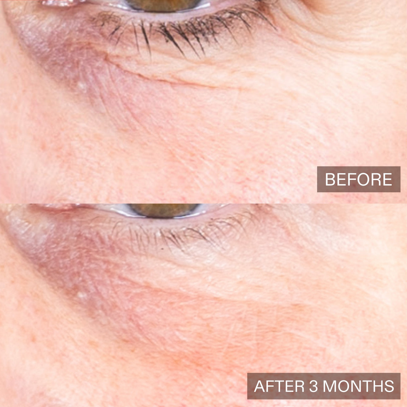 Close-up before-and-after comparison of an eye area showing skin texture and wrinkles, with 'BEFORE' on the top and 'AFTER 3 MONTHS' on the bottom.