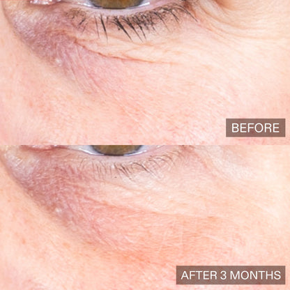 Close-up before-and-after comparison of an eye area showing skin texture and wrinkles, with 'BEFORE' on the top and 'AFTER 3 MONTHS' on the bottom.