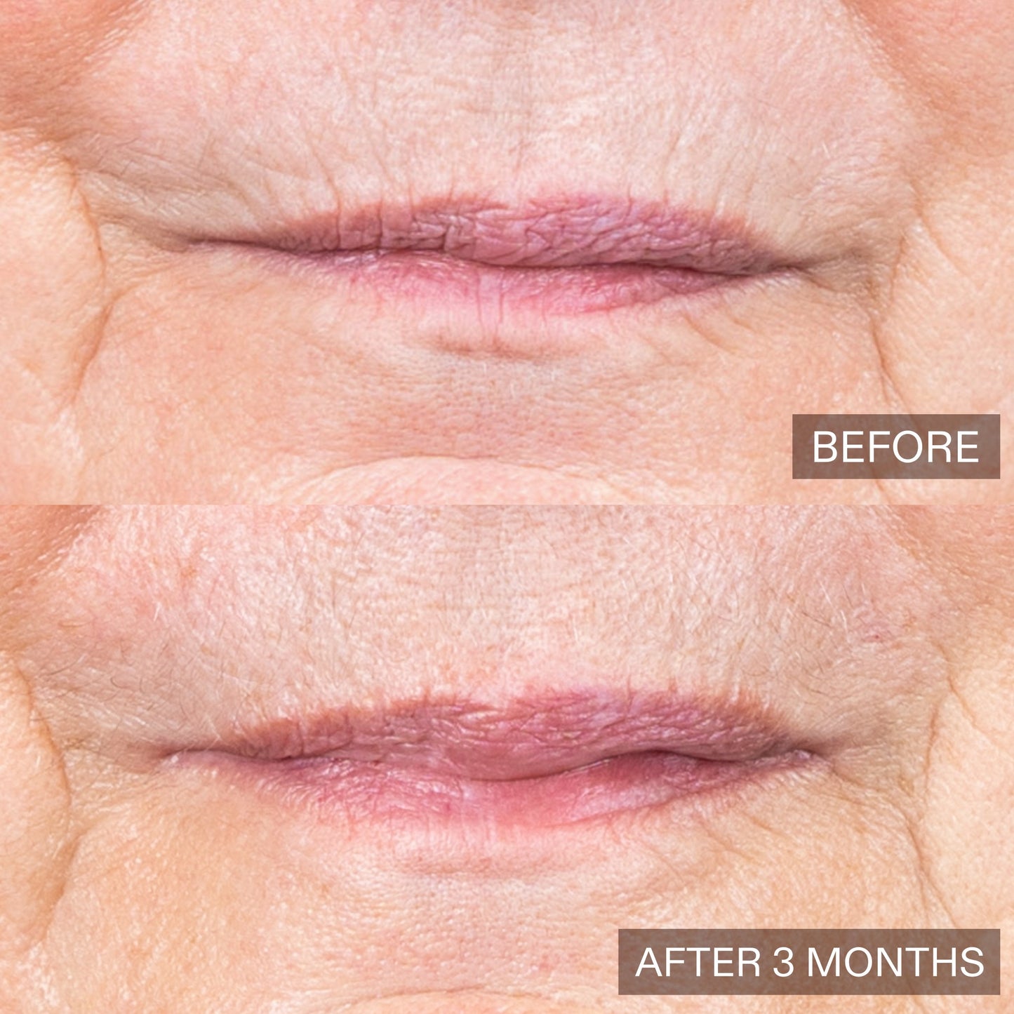 Before-and-after comparison of a person's mouth area showing skin and lip texture after 3 months, with 'BEFORE' on the top and 'AFTER 3 MONTHS' on the bottom.